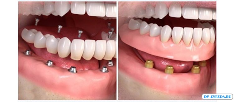 Протезирование зубов. Какой вид протезирования выбрать?