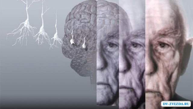 Лечения болезни альцгеймера - Терапия, модифицирующая (изменяющая) течение заболевания