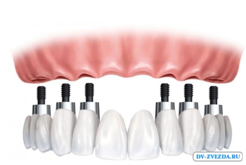 Сколько стоит поставить коронки на зубы